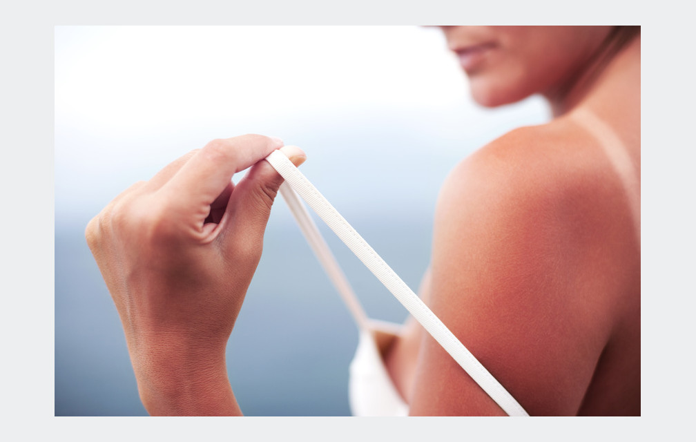 Comment soulager un coup de soleil ?