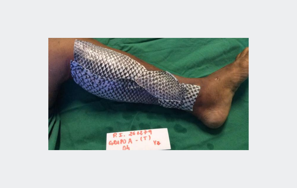 De la peau de poisson pour soigner les brûlures !